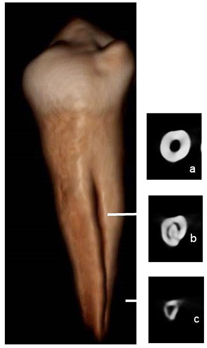 Figura 1. Premolar con surco profundo mostrando los niveles donde se realizó las evaluaciones en coronal, medio y apical.