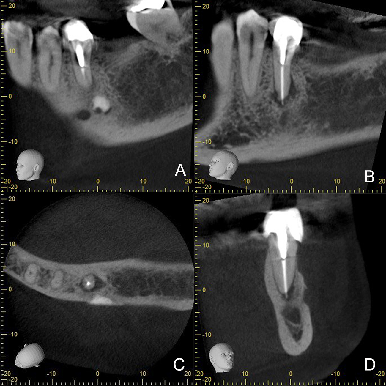 Revista Canal Abierto - Failure Of An Apical Surgery Of A Lower ...