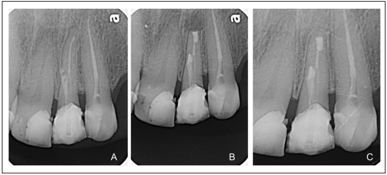 Figura 4. Radiografías de diente 2.2: A: En la evaluación inicial. B: inmediatamente posterior a tratamiento. C:l control de los 8 meses.