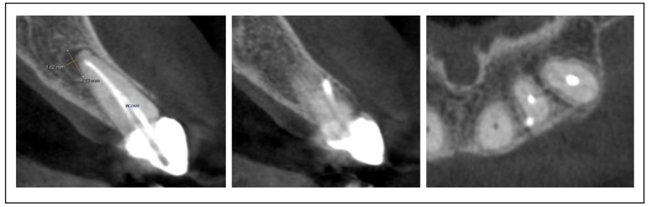 Figura 5. Cortes sagital y transversal de tomografía de haz cónico de diente 2.2.