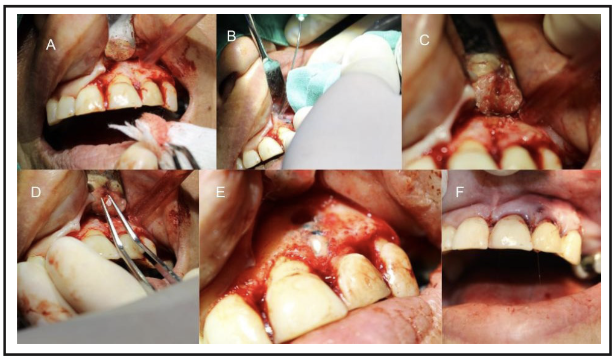 Figura 6. Fotografías de microcirugía apical. A: Perforación expuesta. B: Osteotomía apical. C: Exposición del ápice. D: Ápice dentario extirpado. E: Perforación sellado. F: Suturas.