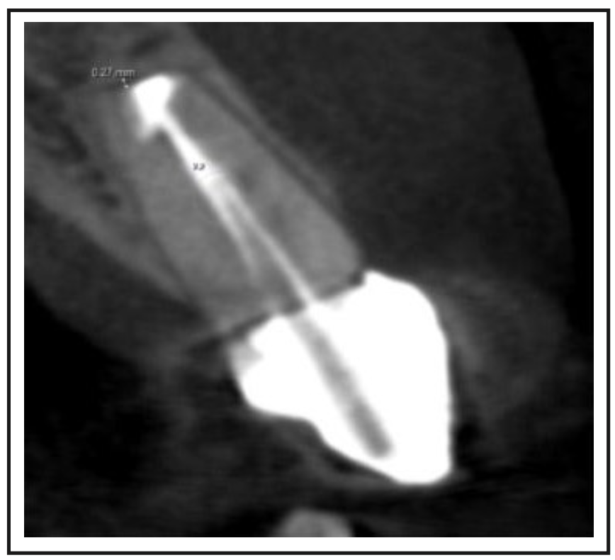 Figura 7. Corte sagital del tomografía de haz cónico del diente 2.2 en el control de 8 meses.