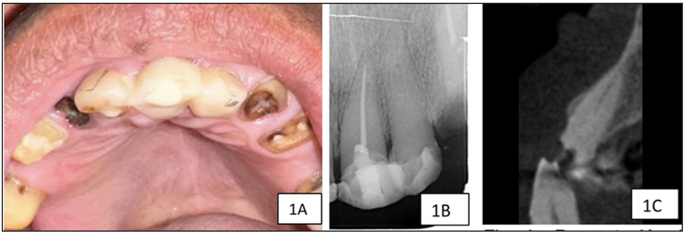 Figura 1 A): PFotografía clínica, B): radiografía periapical previa y C): TCHC previa del diente 2.2. Se observa restauración extensa, calcificación de cámara y canal hasta tercio medio