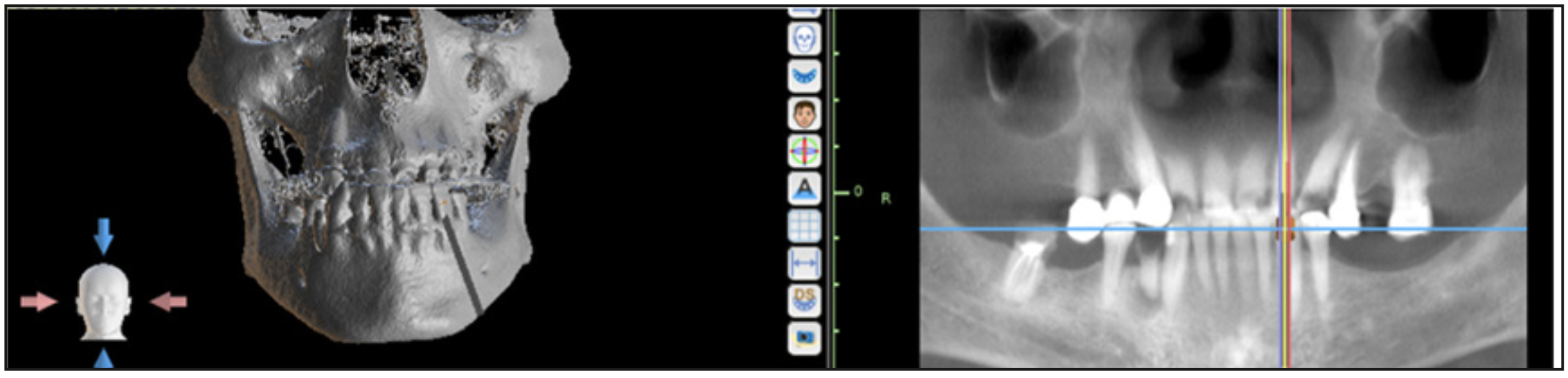 Figura 2. Vista ósea y Panorex del TCHC. Estudio y planificación del diseño de la guía 3D endodóntica.