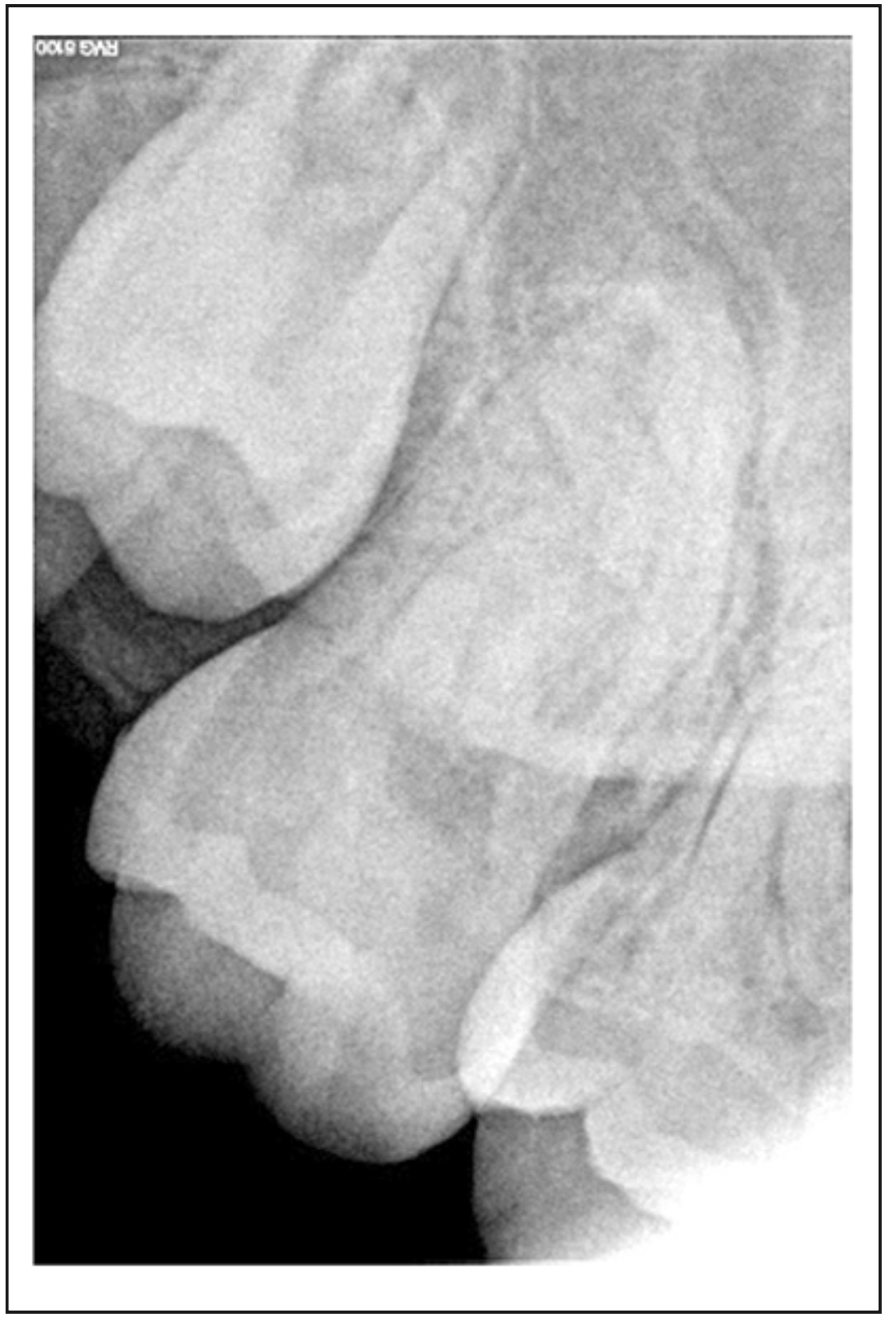 Figura 1. Radiografía inicial diente 1.7