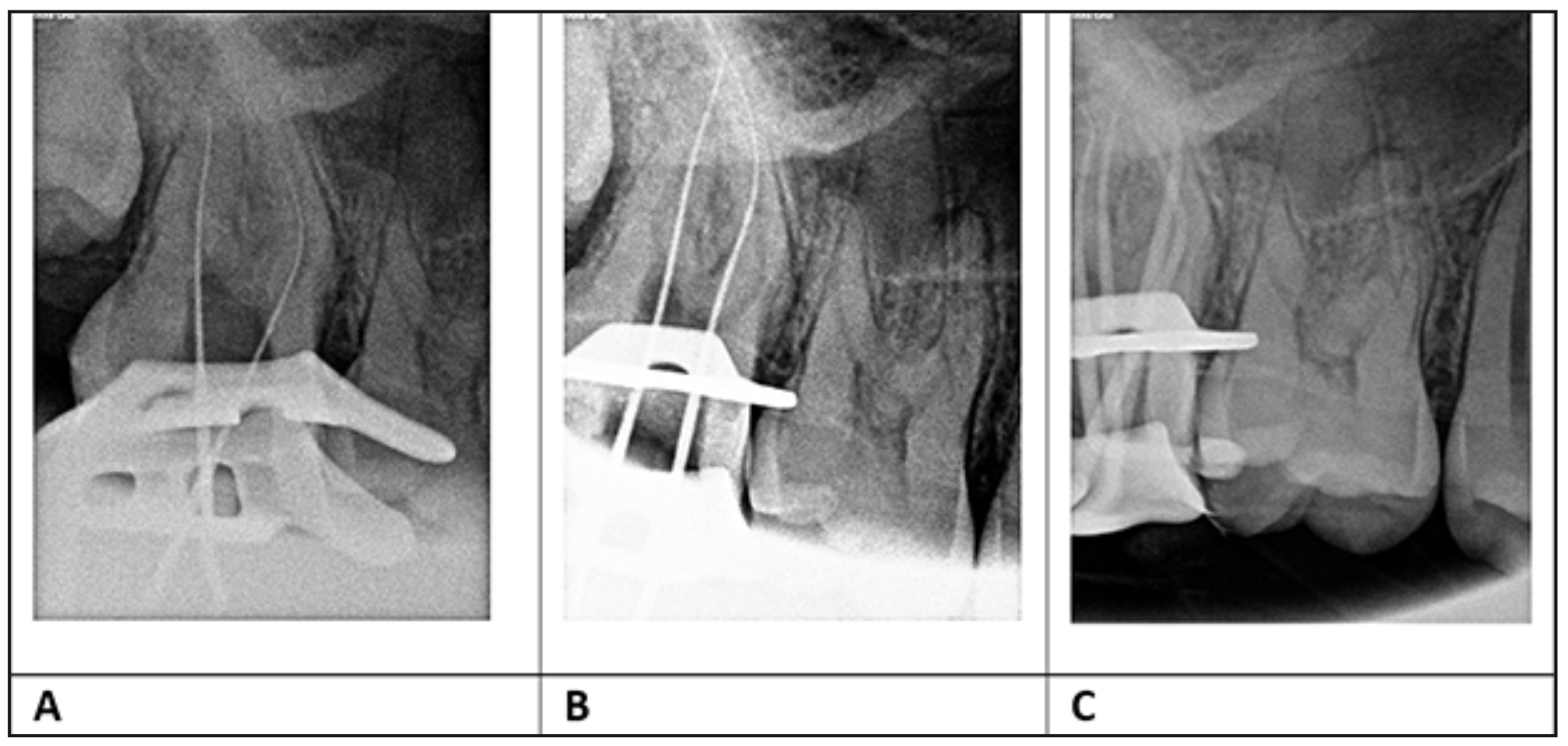 Figura 3. Radiografías del tratamiento endodóntico diente 1.7 A): conductometría de canales vestibulares B): conductometría de canales palatinos C): conometría de los 4 canales