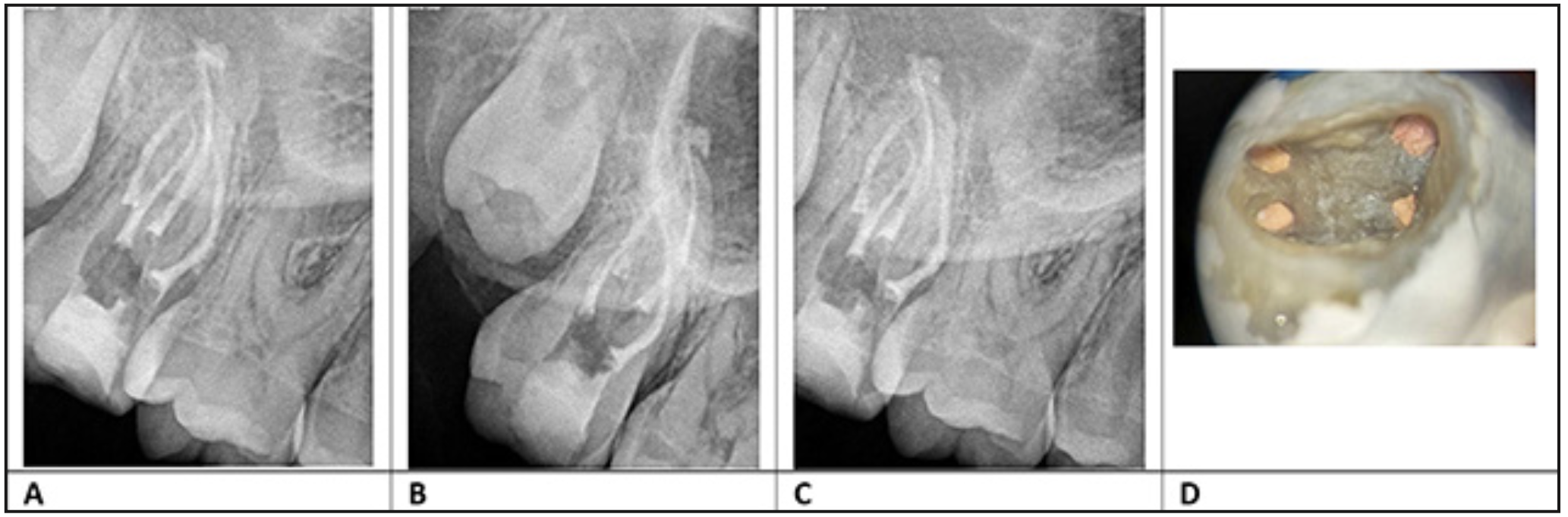 Figura 4. Radiografías de obturación diente 1.7 A): radiografía ortoradial B): radiografía mesializadas C): radiografía distalizada D): fotografía de 4 canales obturados