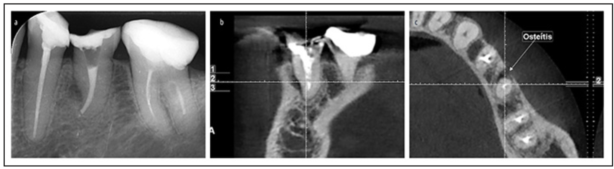 Figura 1. A) radiografía pre operatoria. B) corte coronal tomográfico pre operatorio. C) corte transversal tomográfico preoperatorio.