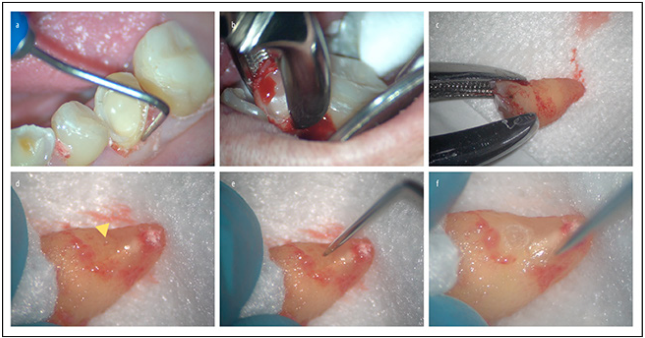Figura 2. A): examen periodontal. B): exodoncia atraumática C): exploración de la superficie radicular. D): identificación del canal lateral. E): exploración del canal latreral. F): preparación del canal lateral.