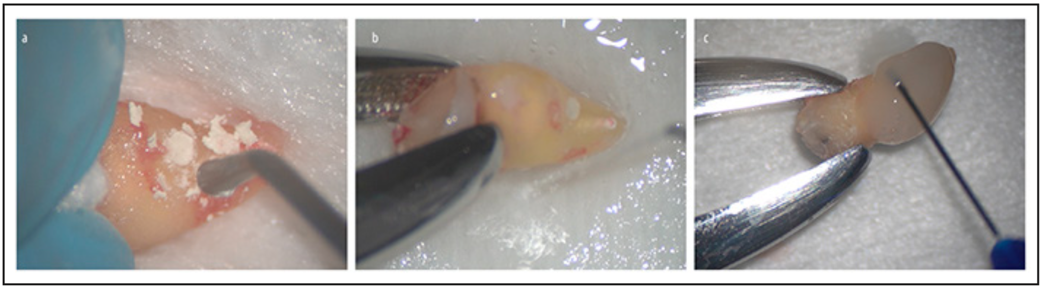Figura 3. A): sellado con material biocerámico en consistencia de masilla (Onefil PT, Mediclus). B): acondicionamiento con EDTA (Prefgel, Straumann). C): aplicacion de amelogeninas en la superficie radicular (Emdogain, Straumann).
