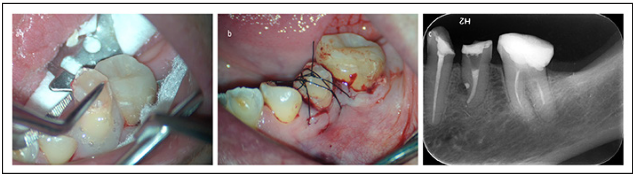Figura 4. A): reposicionamiento del diente en el alveolo. B): estabilización del diente en el alveolo con sutura suspensoria. C): control radiográfico post operatorio.