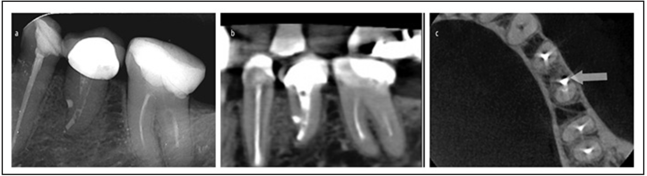 Figura 5. A): radiografía de control 12 meses con el diente rehabilitado. B): corte sagital tomográfico 2 años post operatorio. C): corte transversal tomográfico 2 años post operatorio.